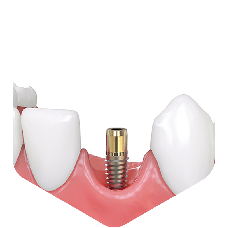 3D illustration of a dental implant without a crown.